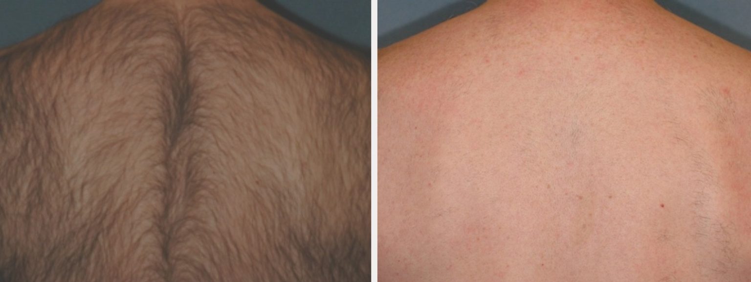 Laser Hair Removal Oswego Montgomery, Aurora, Plainfield, Yorkville, Sugar Grove