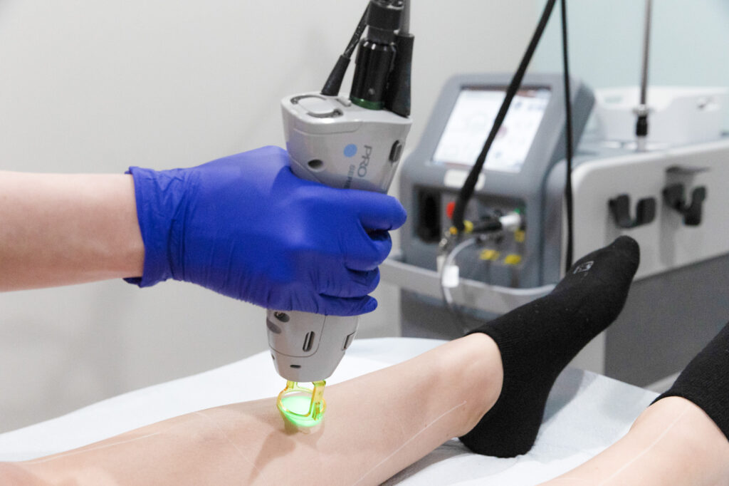 Laser Hair Removal