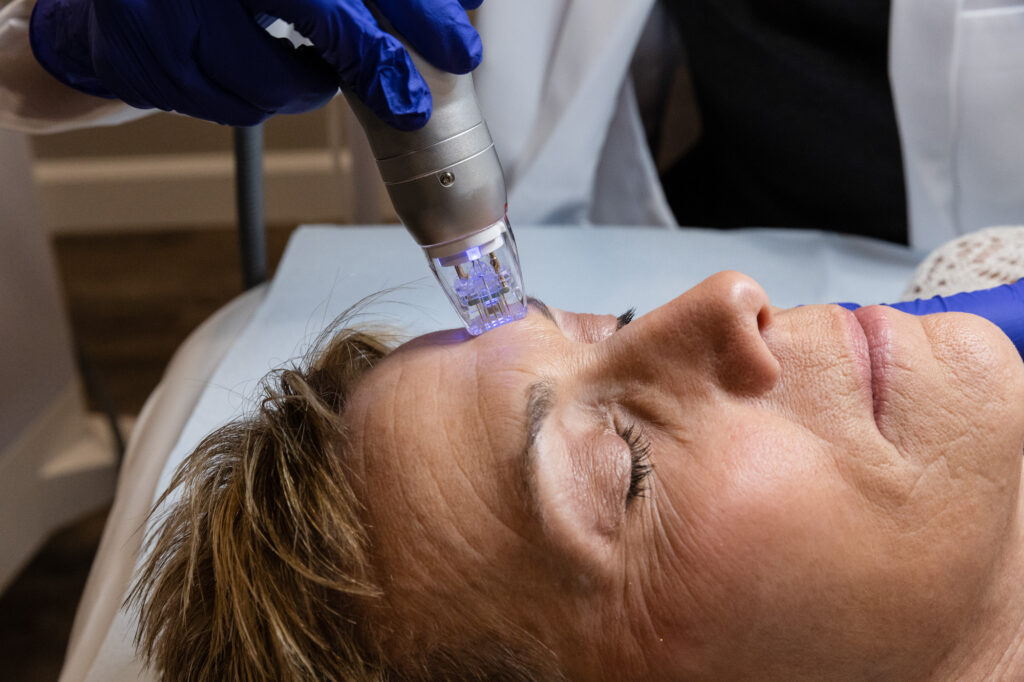 RF Microneedling