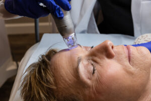 RF Microneedling