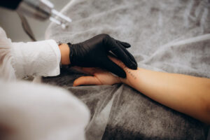 Laser Tattoo Removal