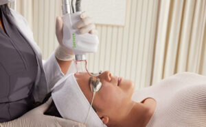 CO2 Laser Treatment