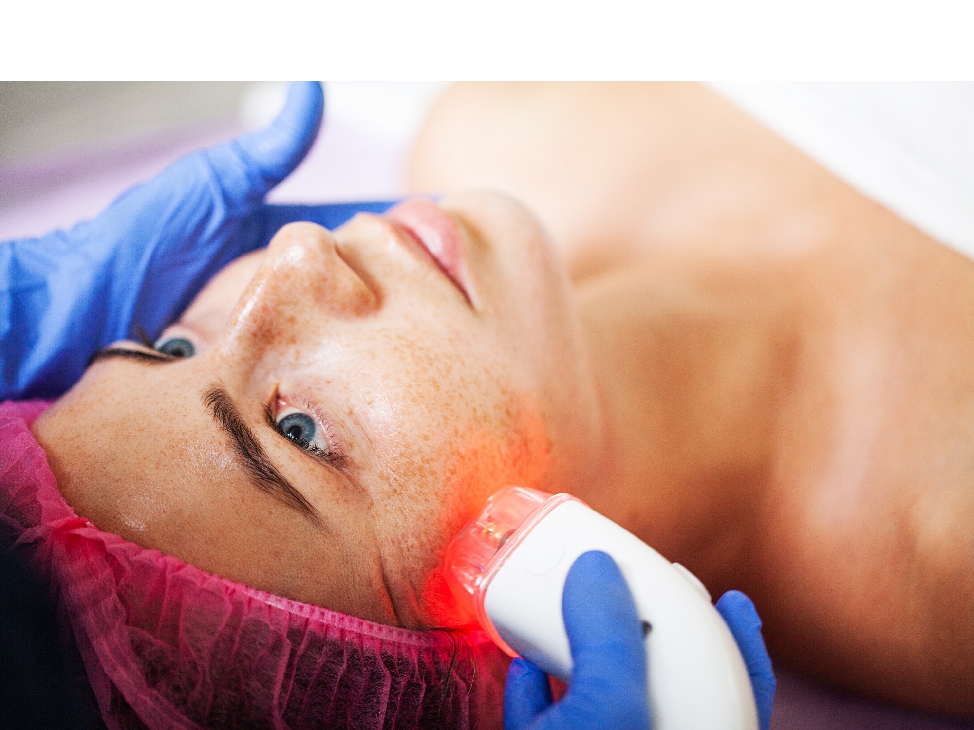 BBL Photofacial