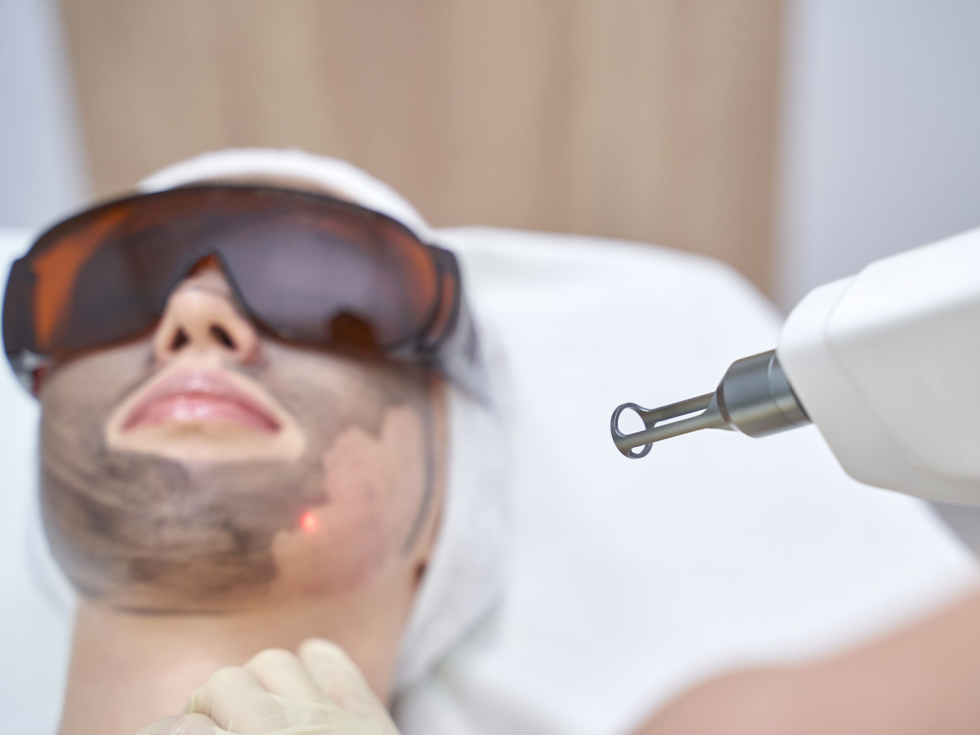 CO2 Laser Resurfacing