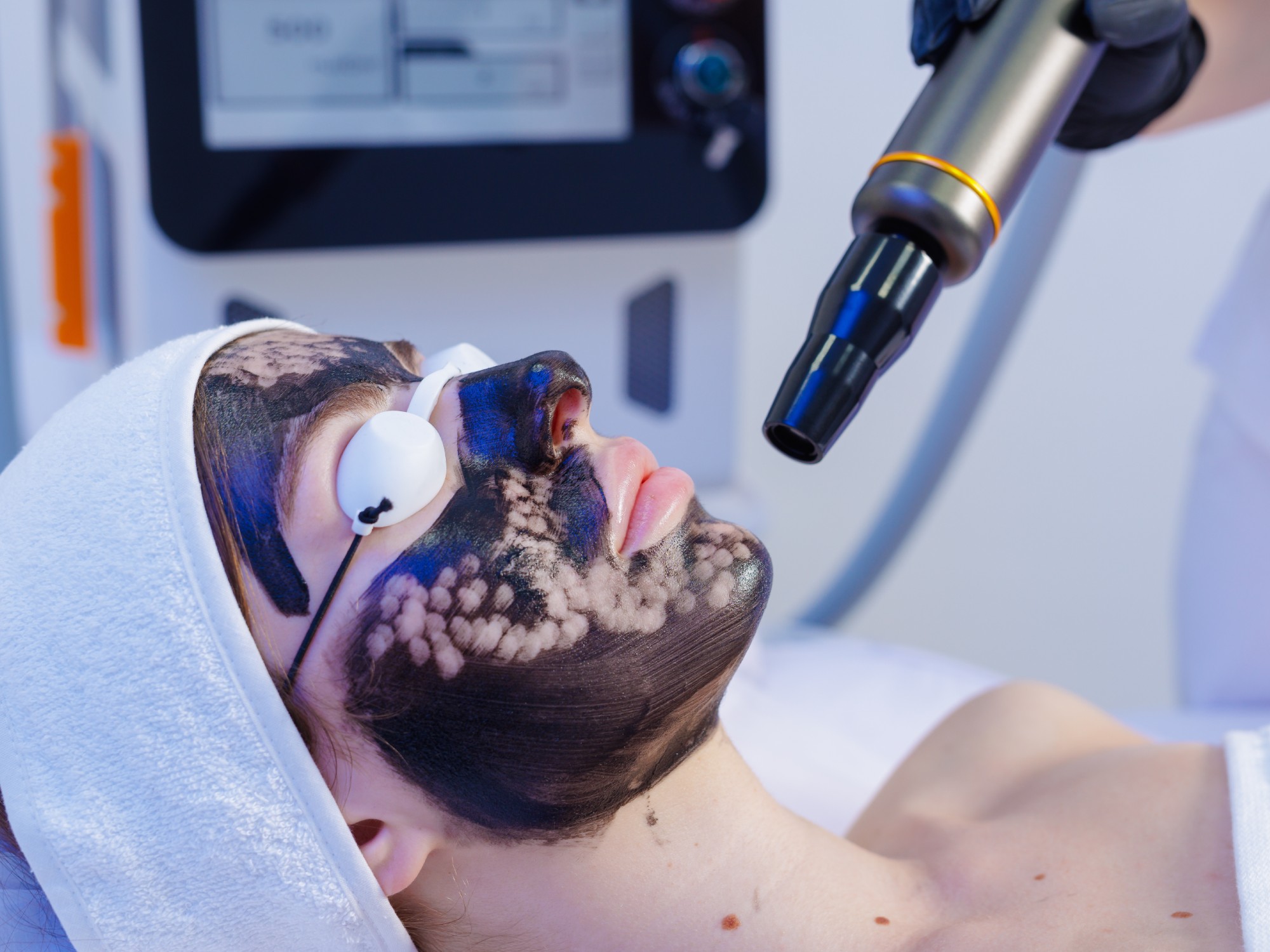 CO2 Laser Resurfacing