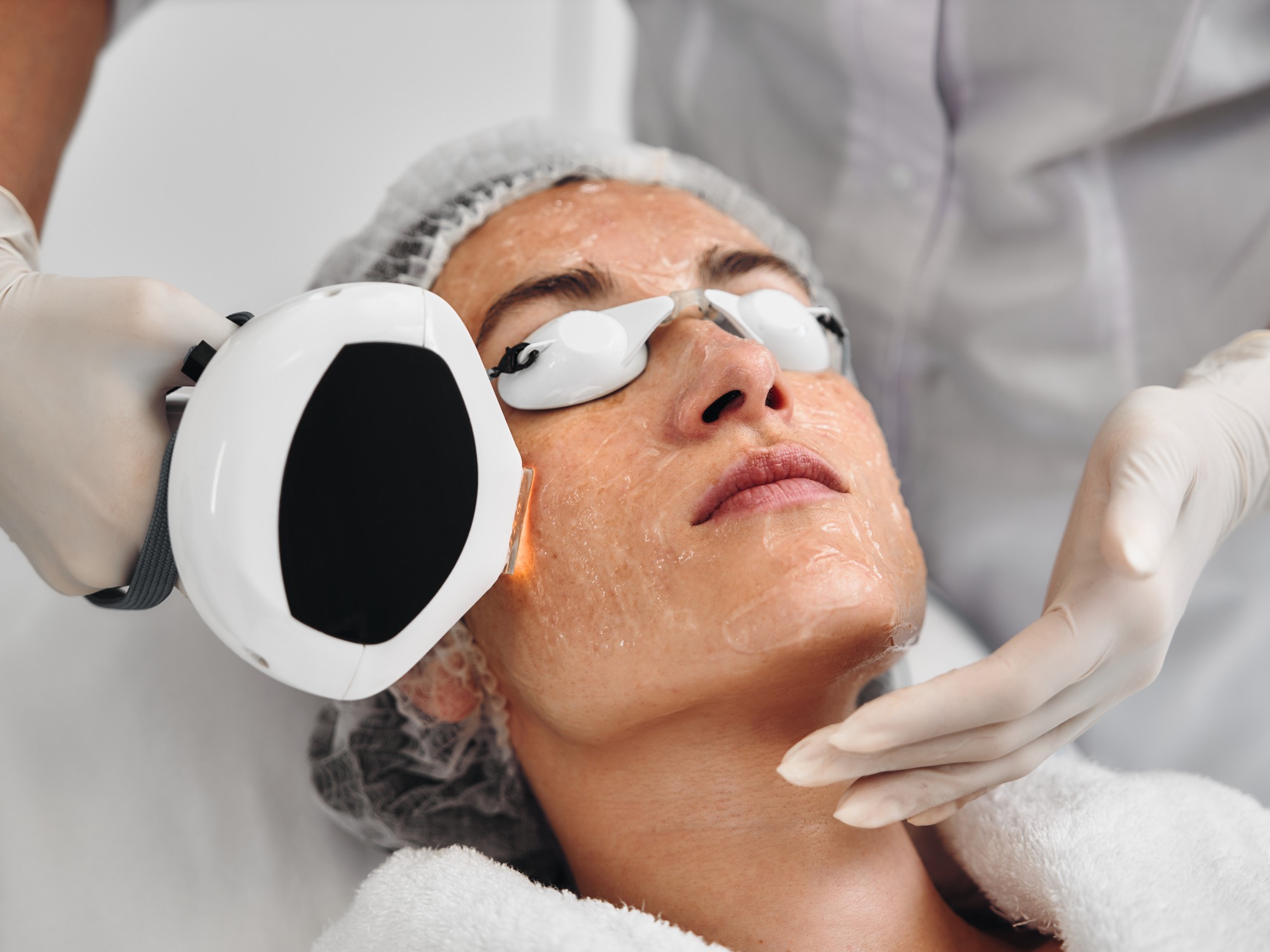ERBIUM YAG LASER RESURFACING