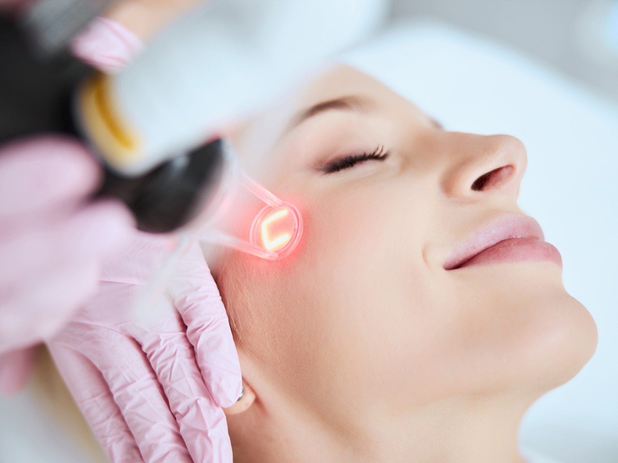 HALO Laser Resurfacing