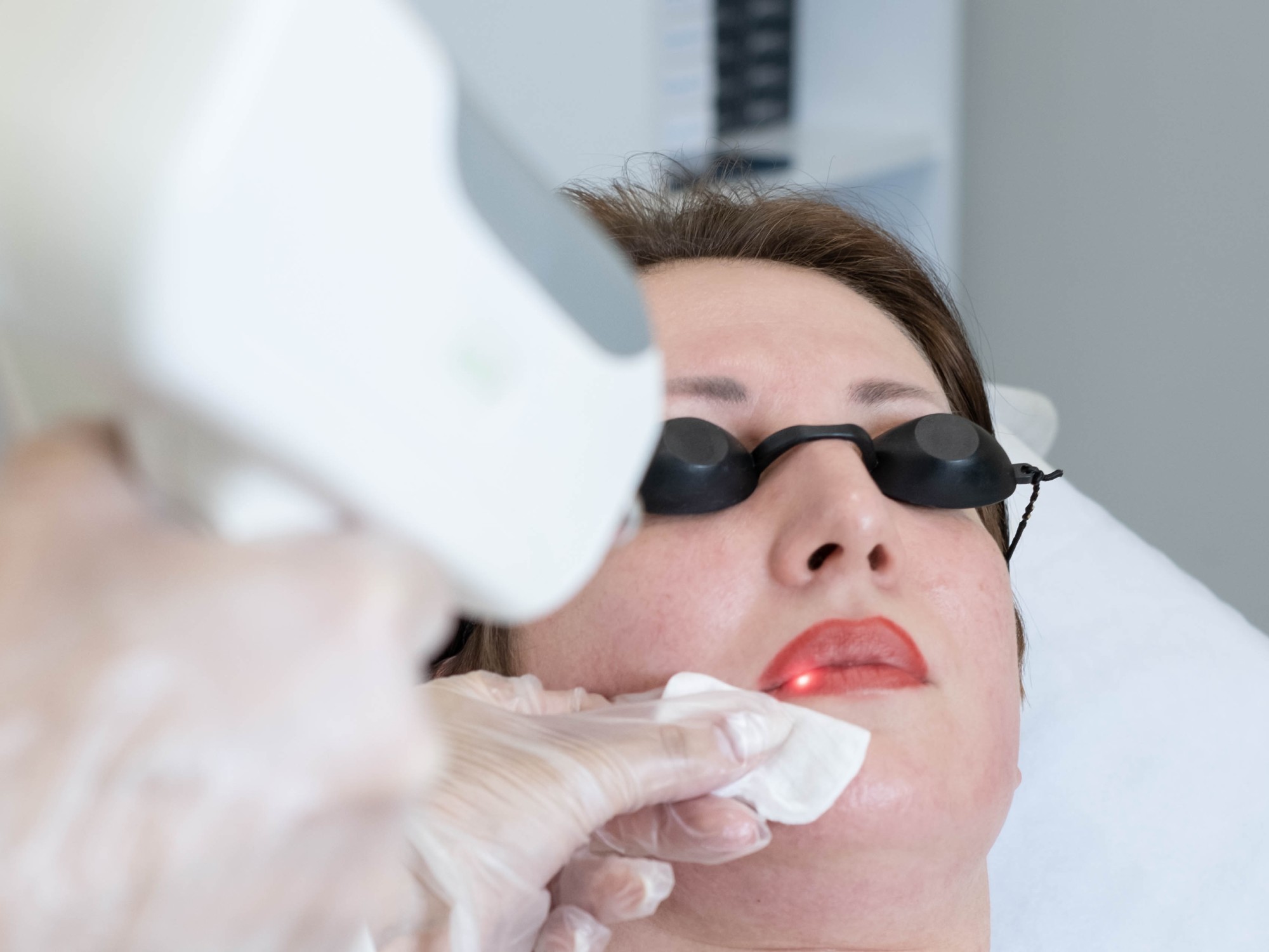 HALO Laser Resurfacing