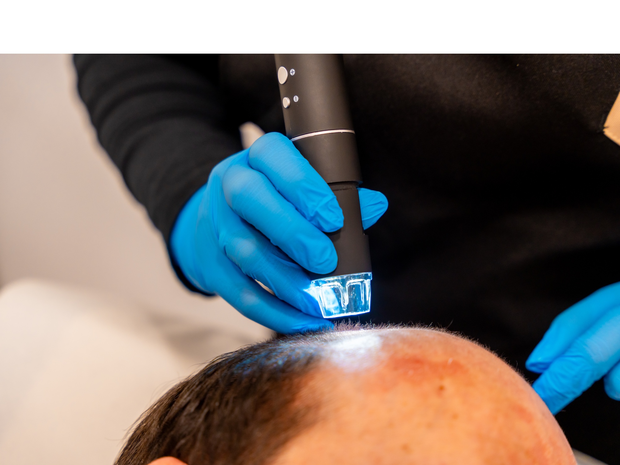 KeraLase Hair Restoration