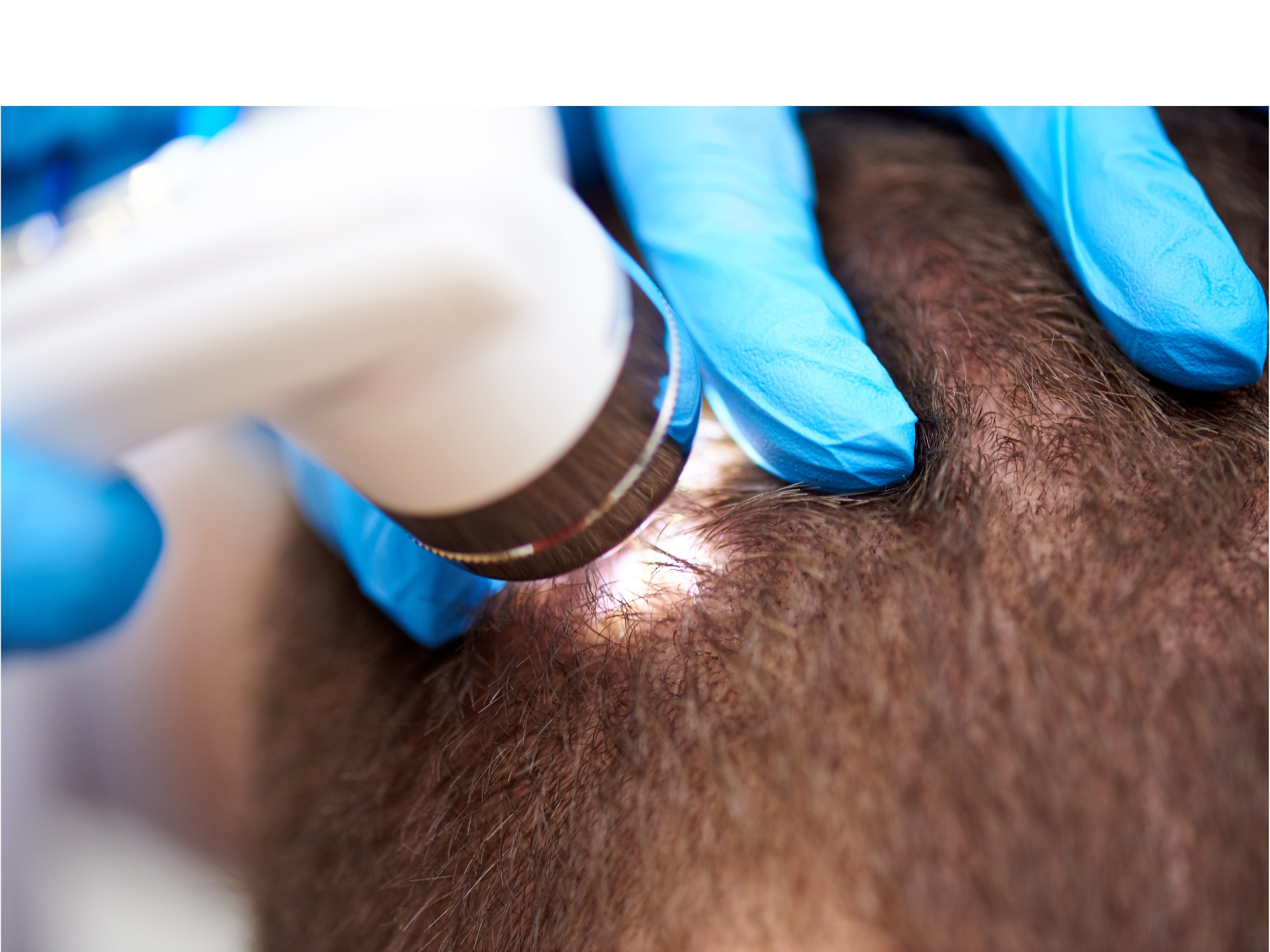 KeraLase Hair Restoration