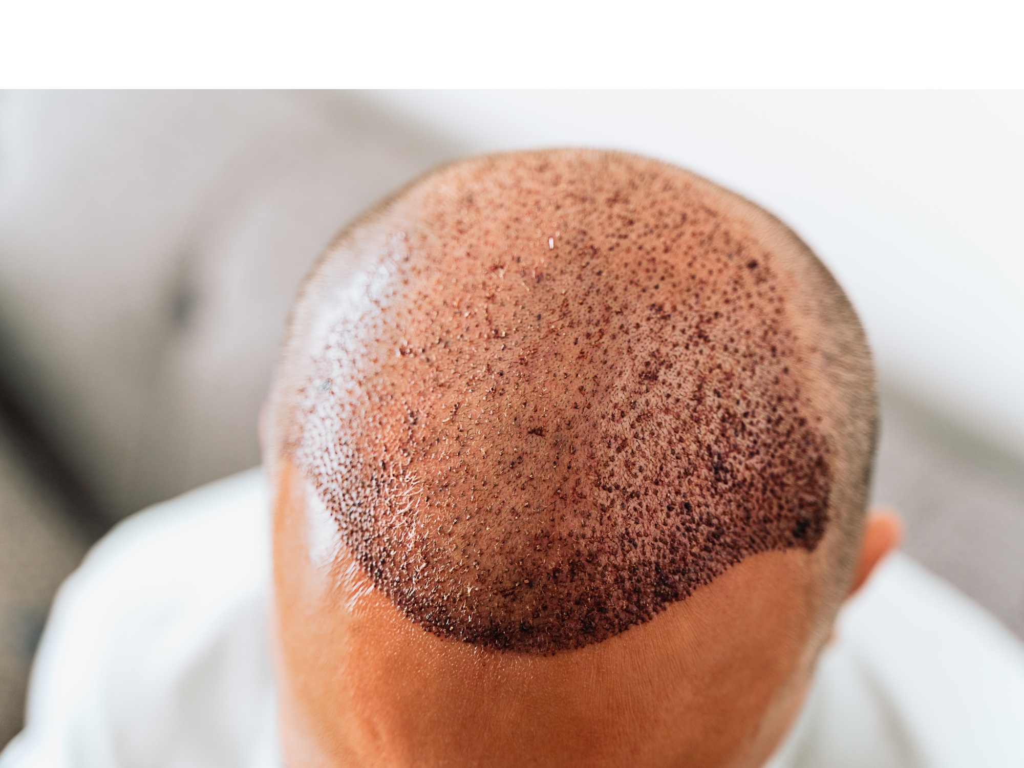 KeraLase Hair Restoration