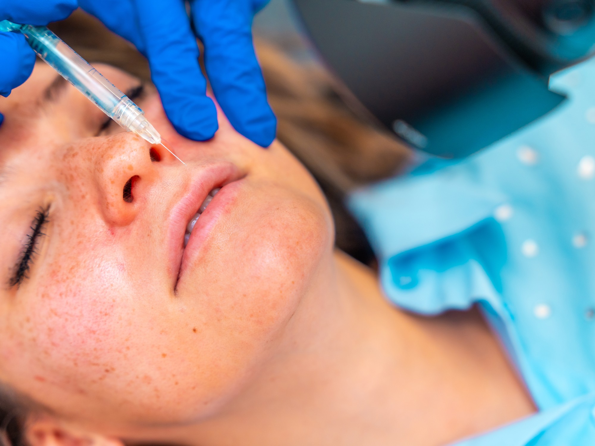 Microneedling with Exosomes