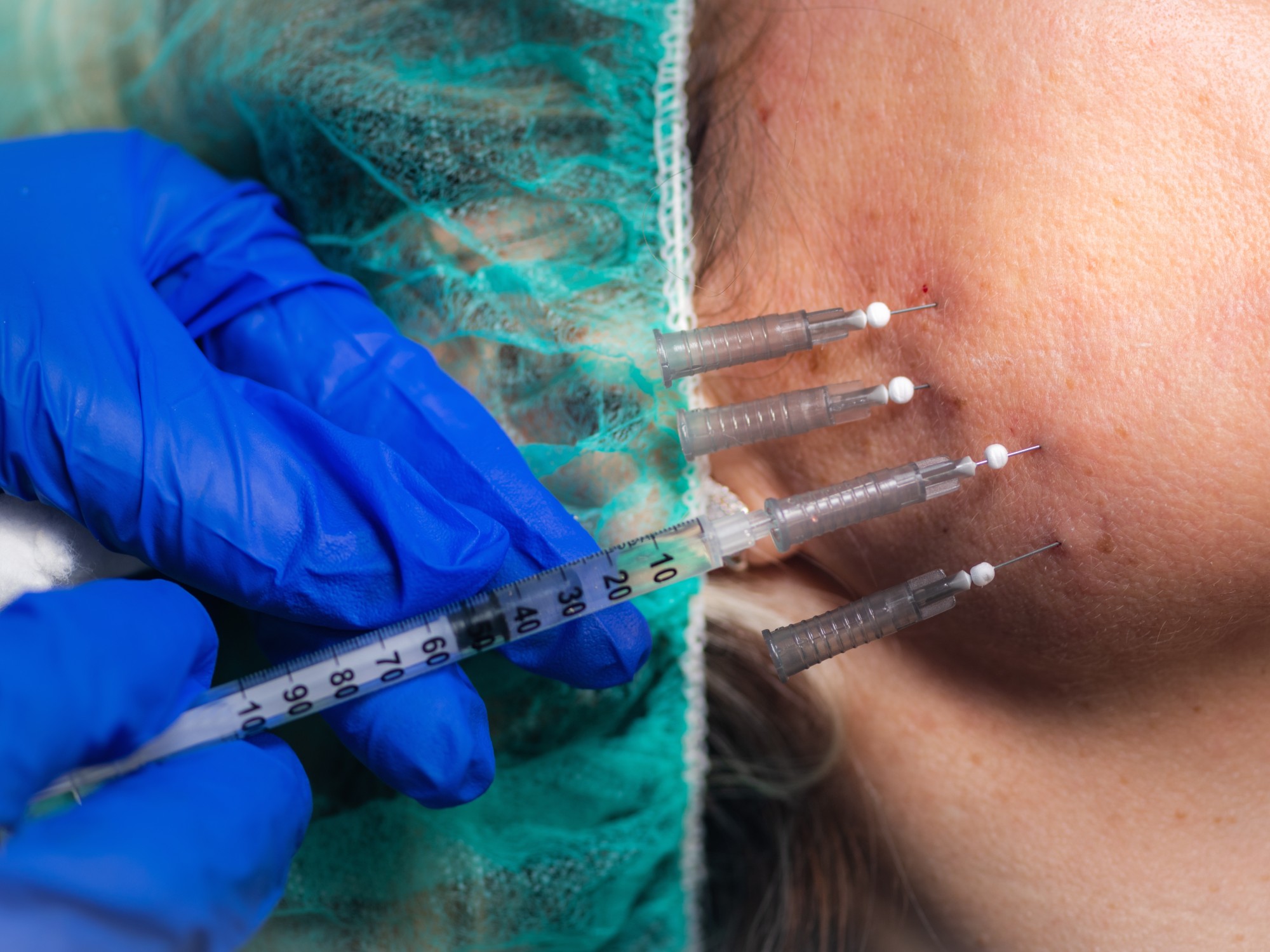 Microneedling with Exosomes