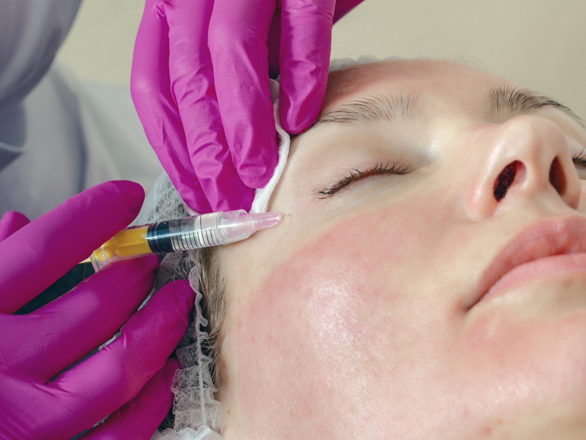 Microneedling with Exosomes