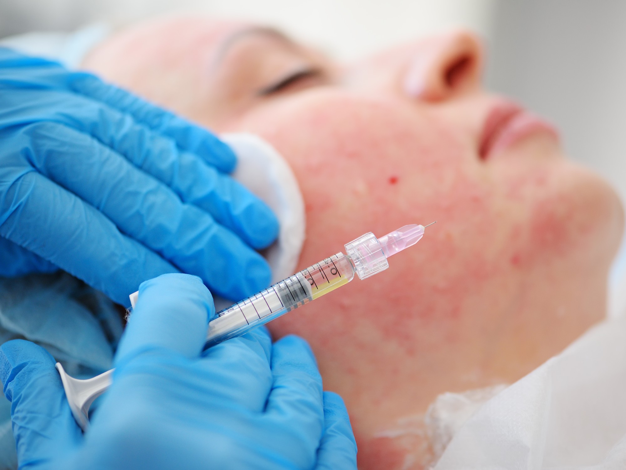 Microneedling with Exosomes
