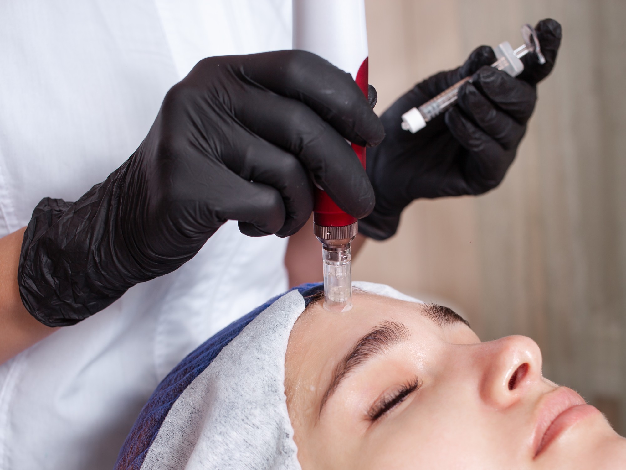 Microneedling with PRP