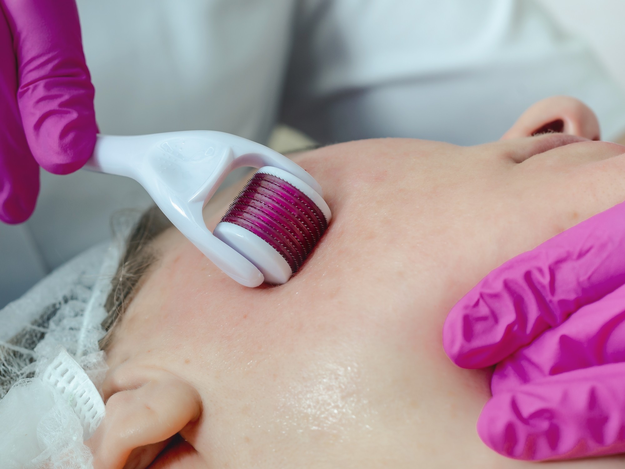 Microneedling with PRP