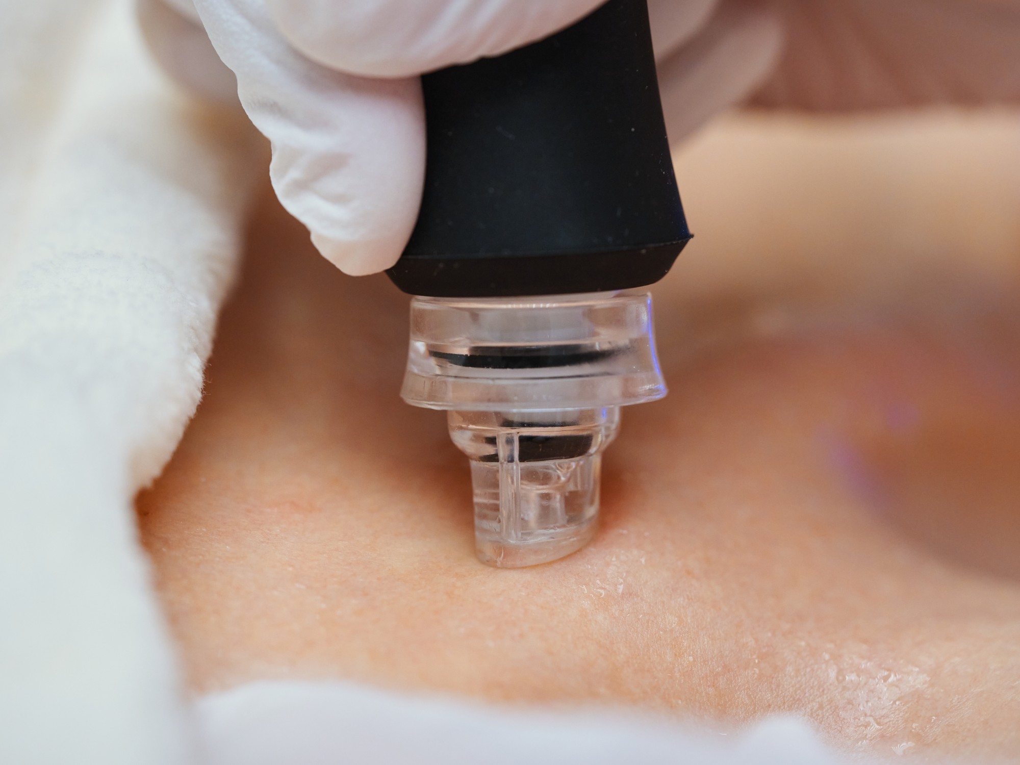 Microneedling with PRP