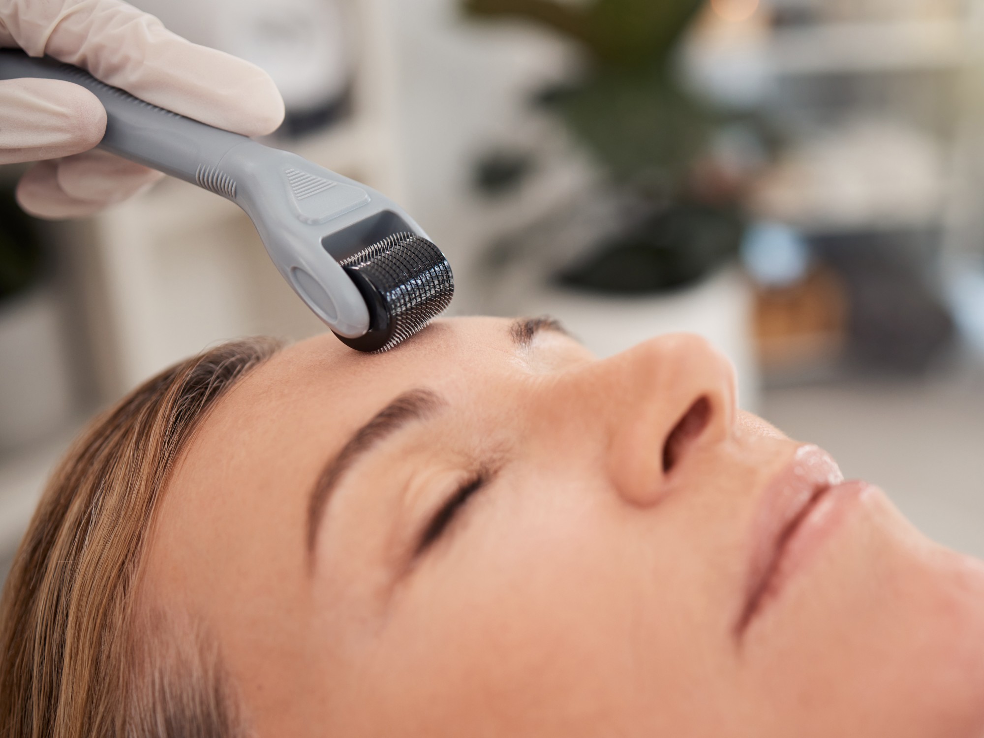 Microneedling with PRP