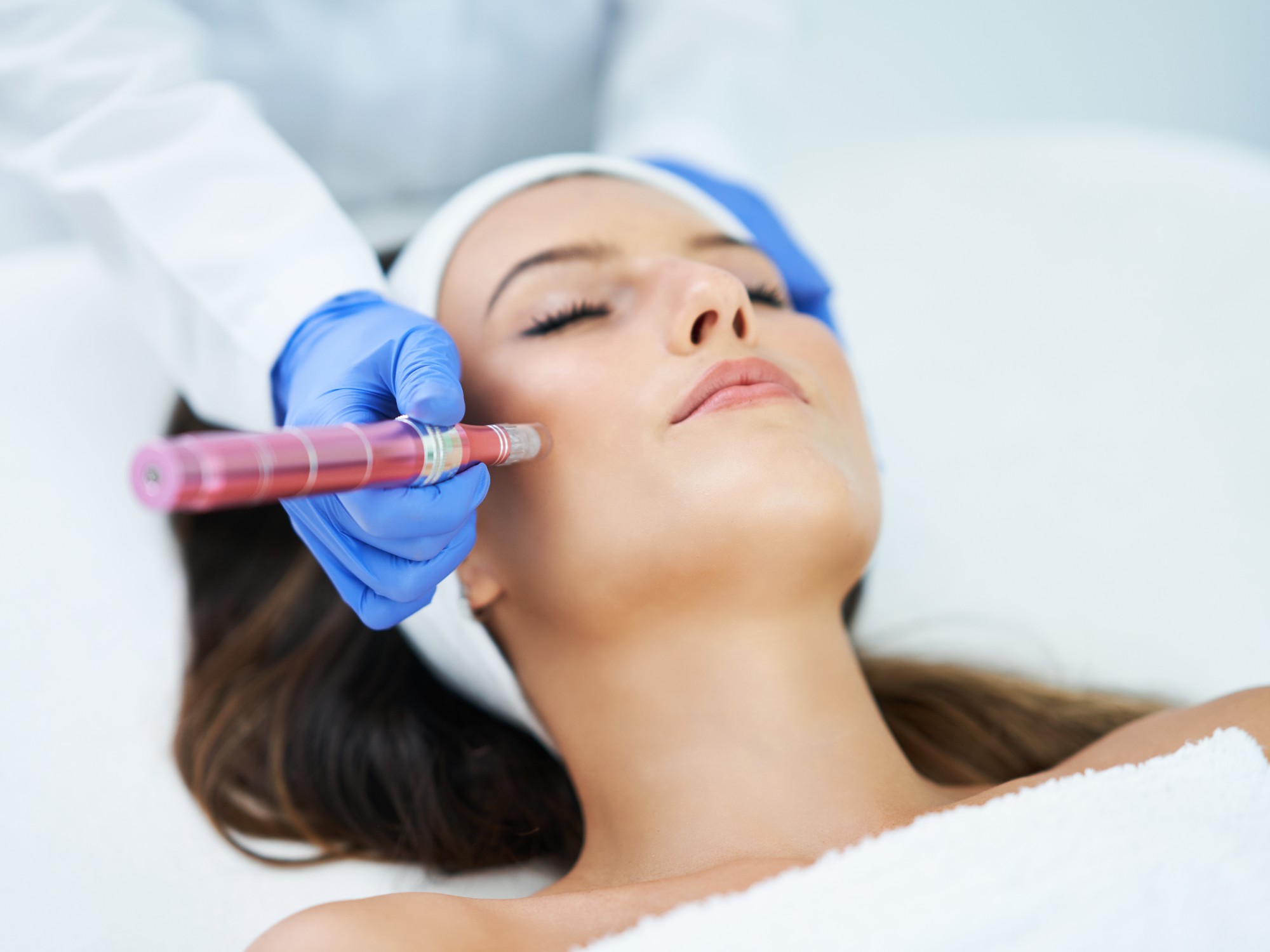 Microneedling with PRP