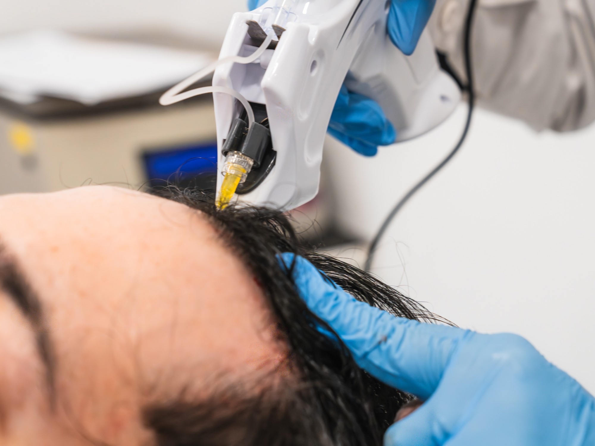 PRP Hair Restoration Expanded