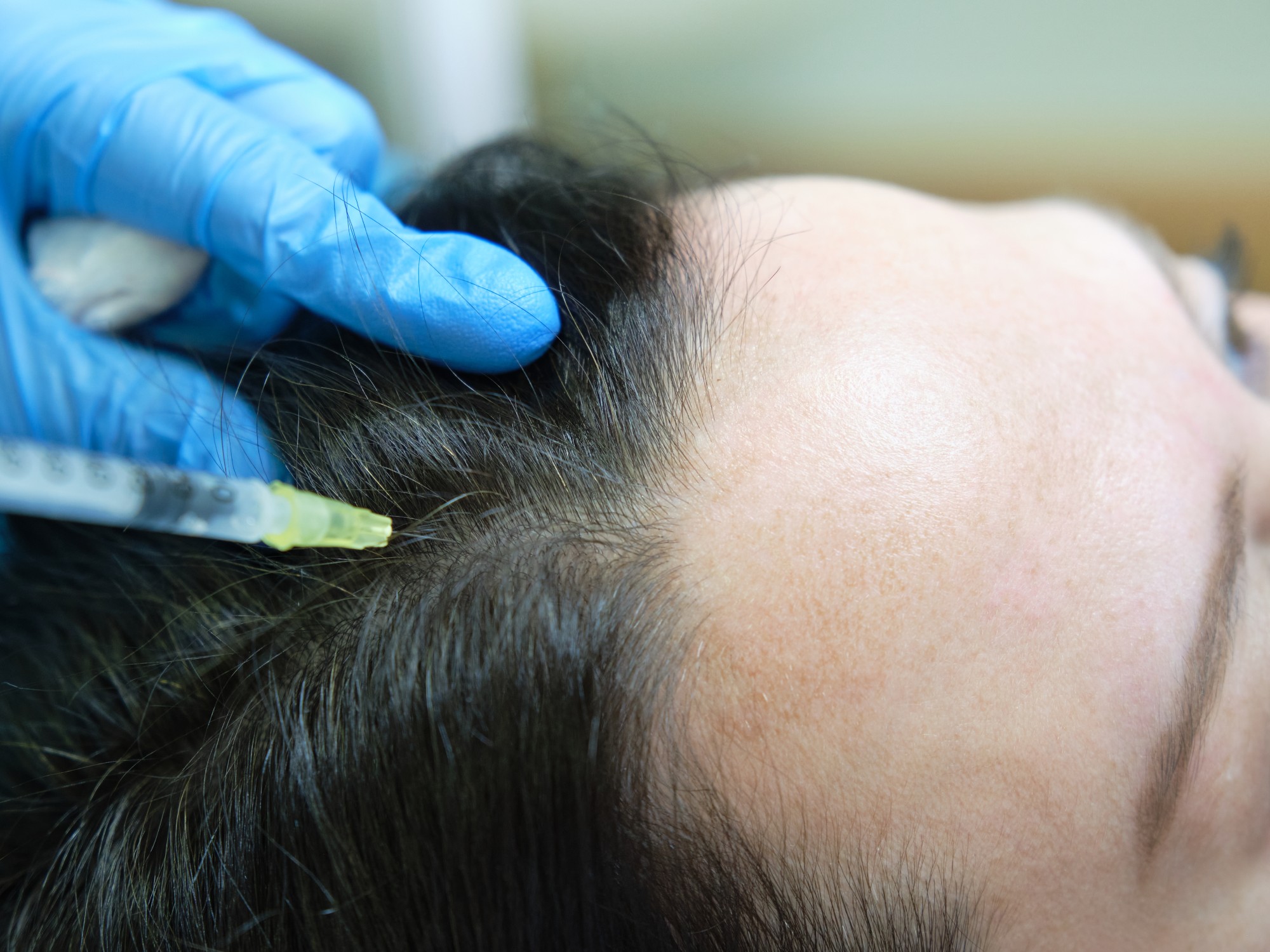 PRP Hair Restoration Expanded