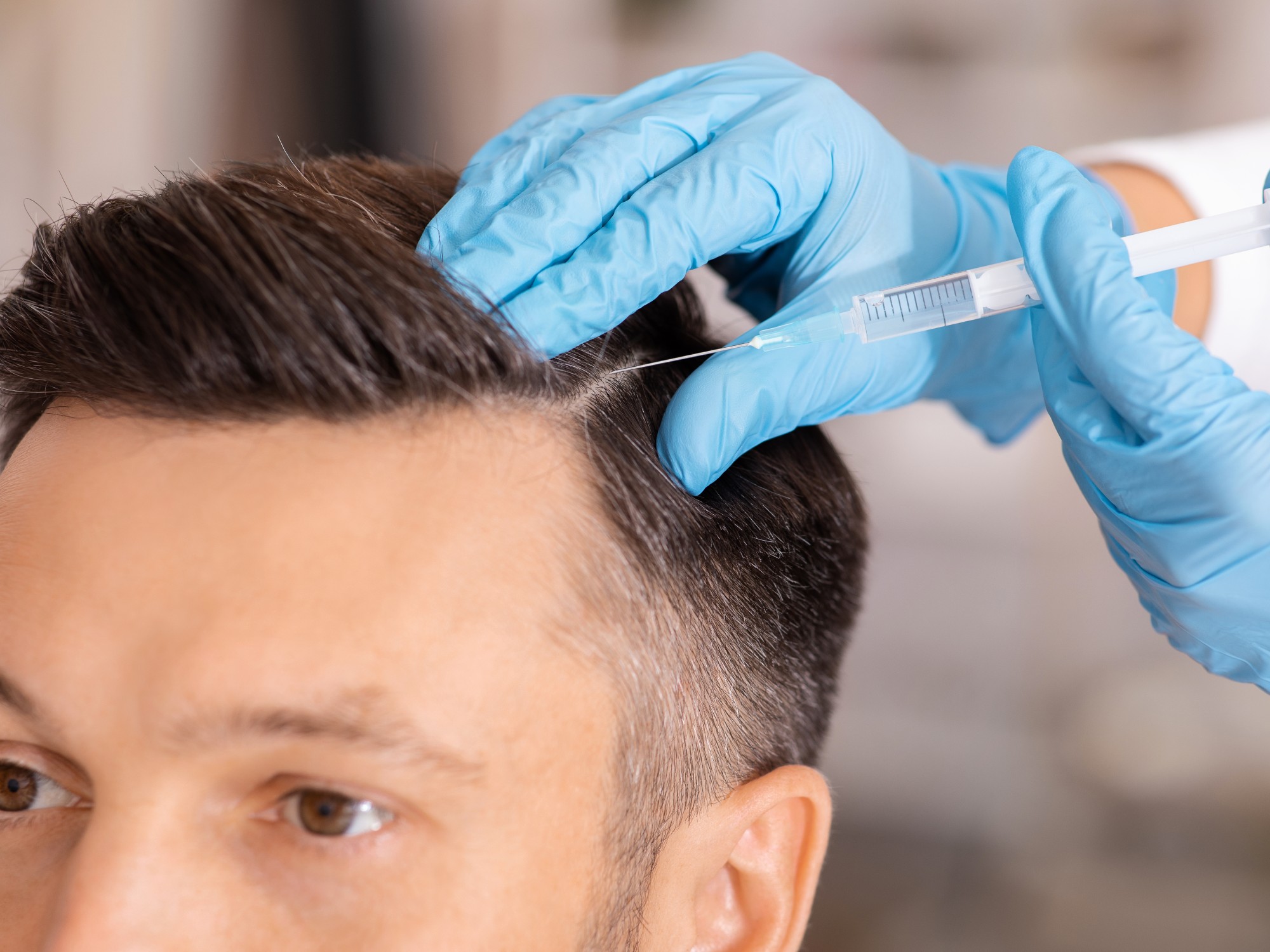 PRP Hair Restoration Expanded