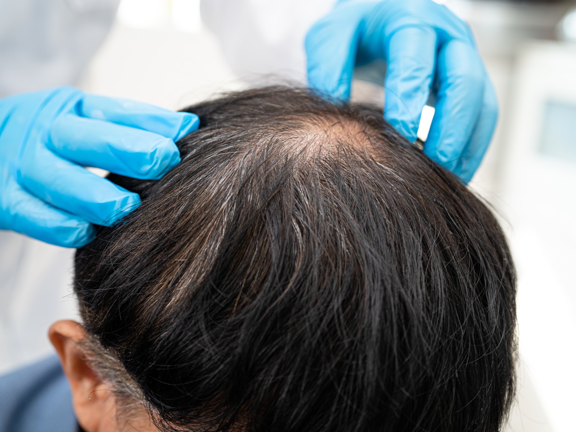 PRP Hair Restoration Expanded