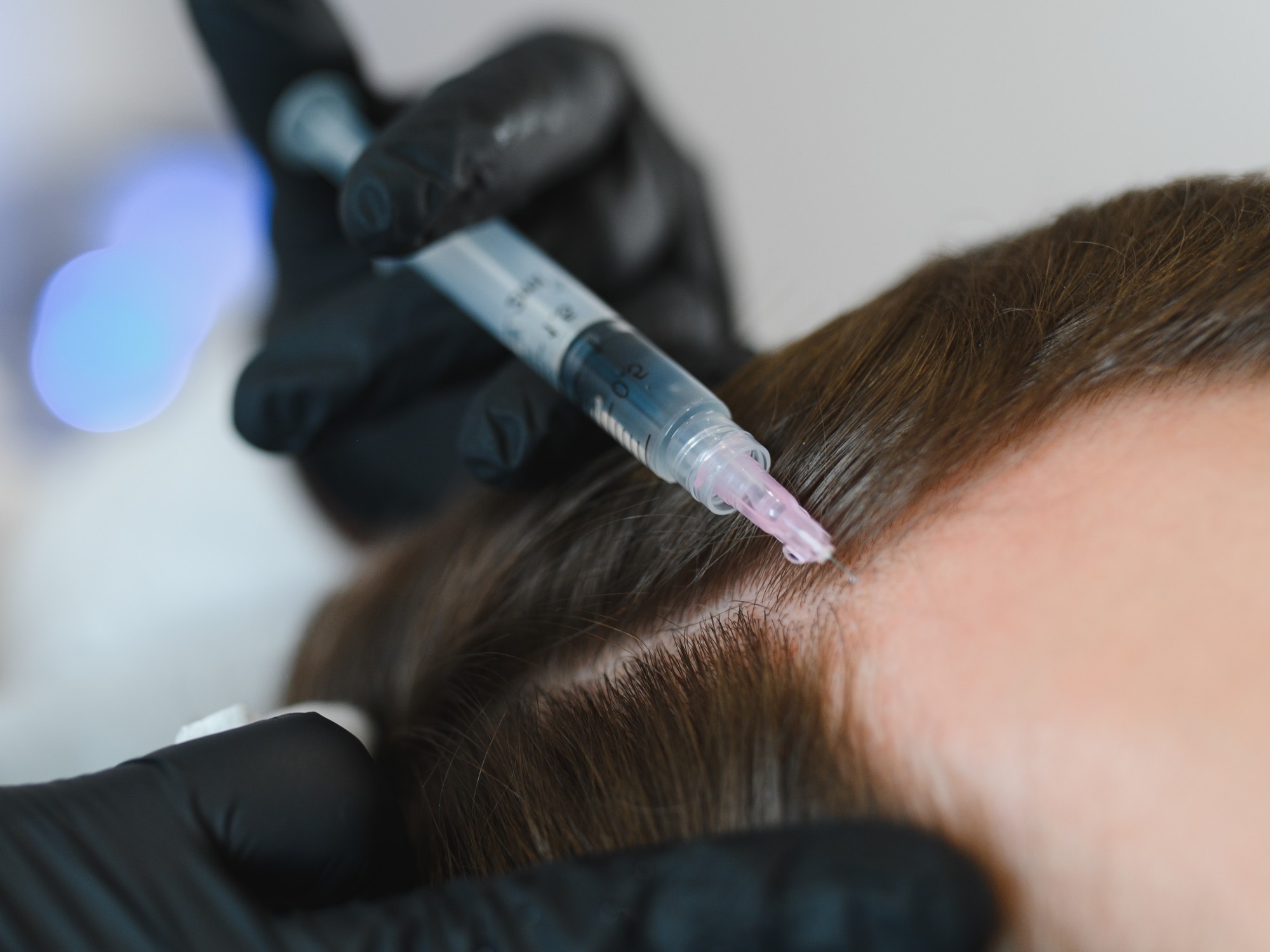 PRP Hair Restoration Expanded