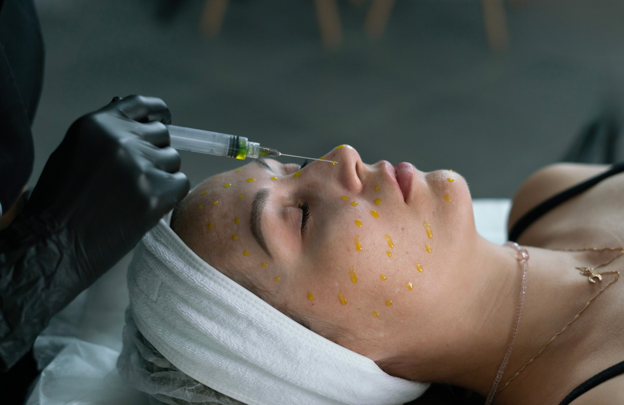 Depigmentation Mesotherapy