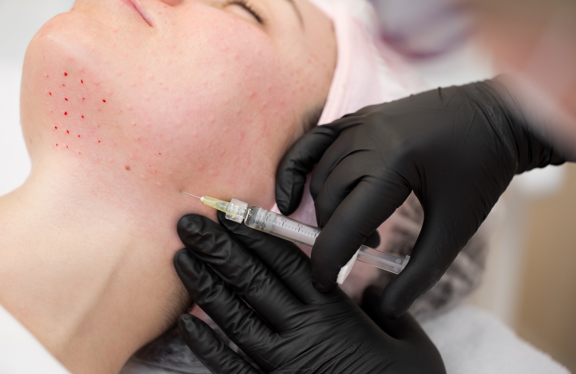 Depigmentation Mesotherapy