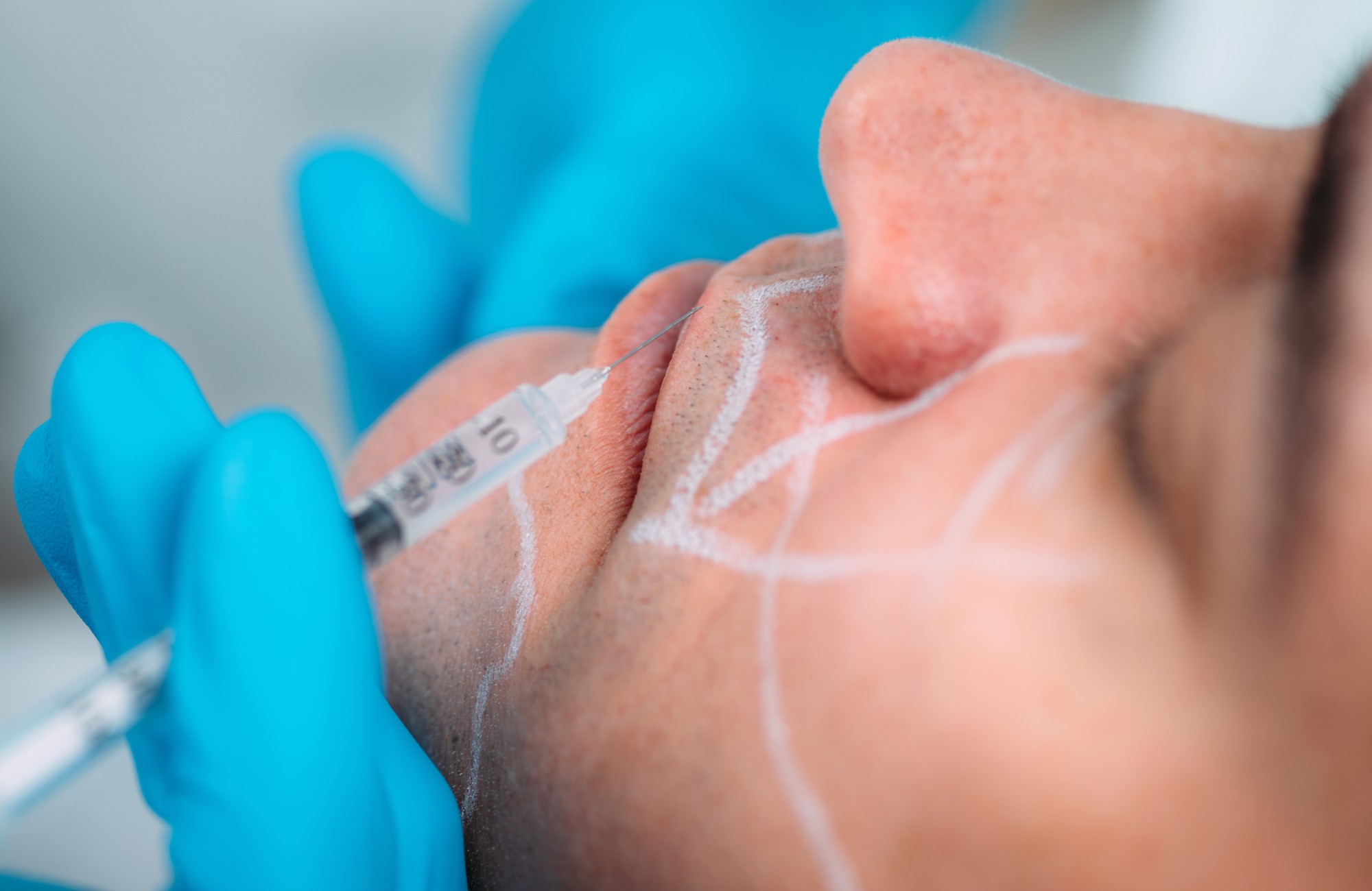 Depigmentation Mesotherapy