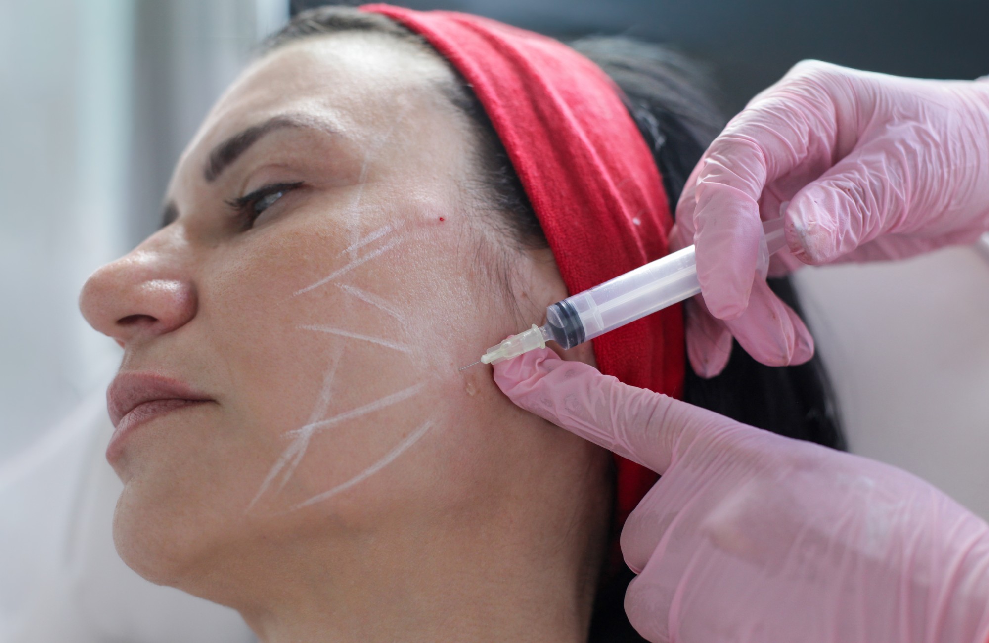 Photoaging Recovery Mesotherapy