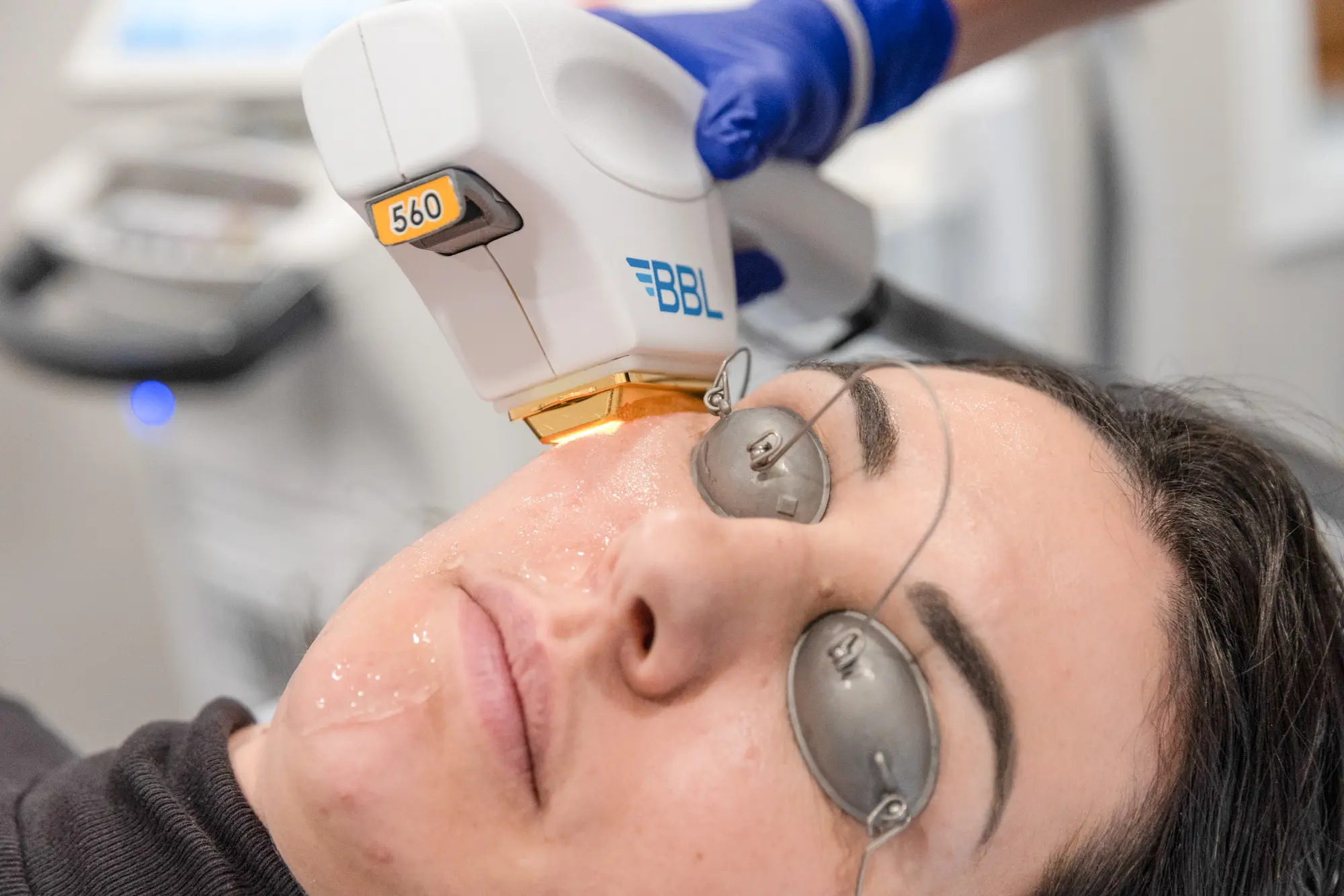 BBL HERO Photofacial